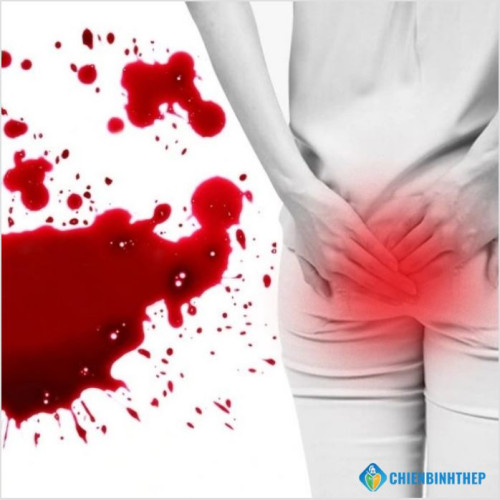 Trĩ Chảy Máu Có Nguy Hiểm Không? Hướng Dẫn Cầm Máu Tức Thời Tại Nhà