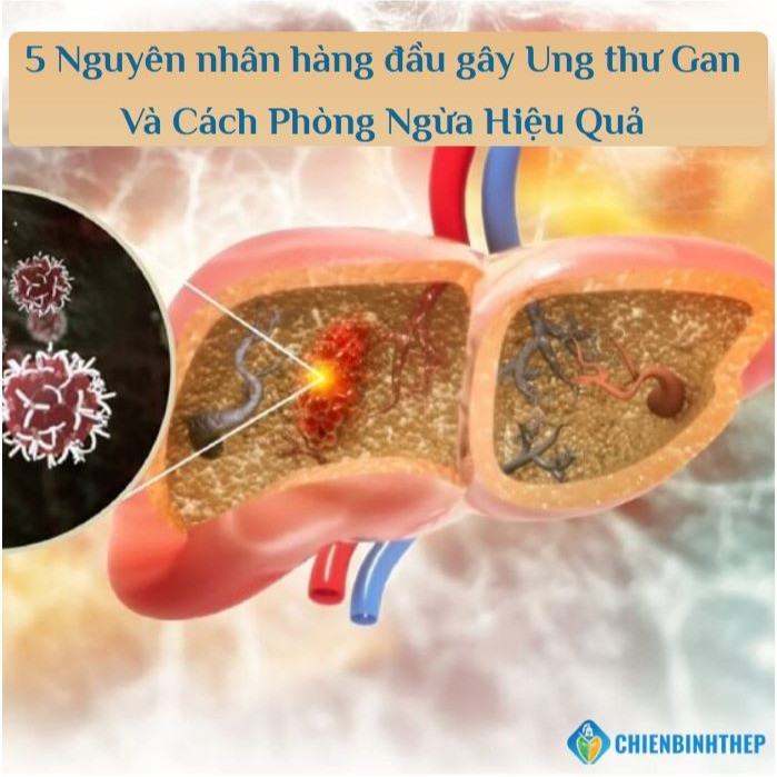 Ung Thư Gan: Vạch Mặt 5 Nguyên Nhân Hàng Đầu Và Xây Dựng Lá Chắn Phòng Bệnh Cho Gia Đình Việt