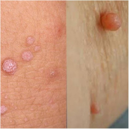 Phân Biệt Mụn Cóc Và Mụn Thịt: 3 Dấu Hiệu Vàng Giúp Bạn An Tâm