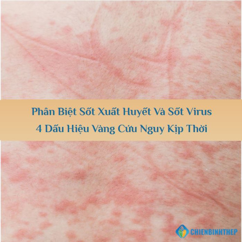 Phân Biệt Sốt Xuất Huyết Và Sốt Virus: 4 Dấu Hiệu Vàng Cứu Nguy Kịp Thời
