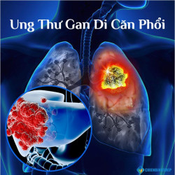 Ung Thư Gan Di Căn Phổi: Triệu Chứng Sớm Và Liệu Pháp Kéo Dài Sự Sống Mới Nhất