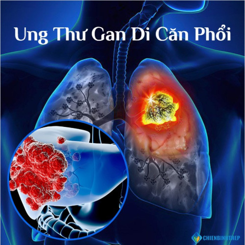 Ung Thư Gan Di Căn Phổi: Triệu Chứng Sớm Và Liệu Pháp Kéo Dài Sự Sống Mới Nhất