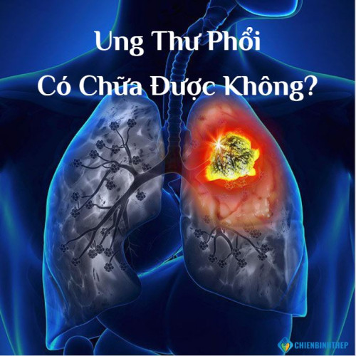 Ung thư phổi có chữa được không? Câu trả lời đầy đủ và Phác đồ điều trị mới nhất 2025