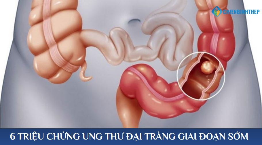 Dấu hiệu ung thư đại tràng giai đoạn sớm cần lưu ý