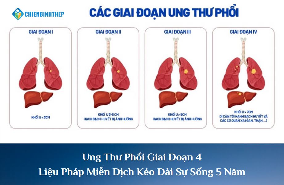 Ung Thư Phổi Giai Đoạn 4: Liệu Pháp Miễn Dịch Kéo Dài Sự Sống 5 Năm