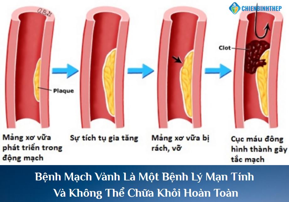 Bệnh mạch vành không thể chữa khỏi hoàn toàn