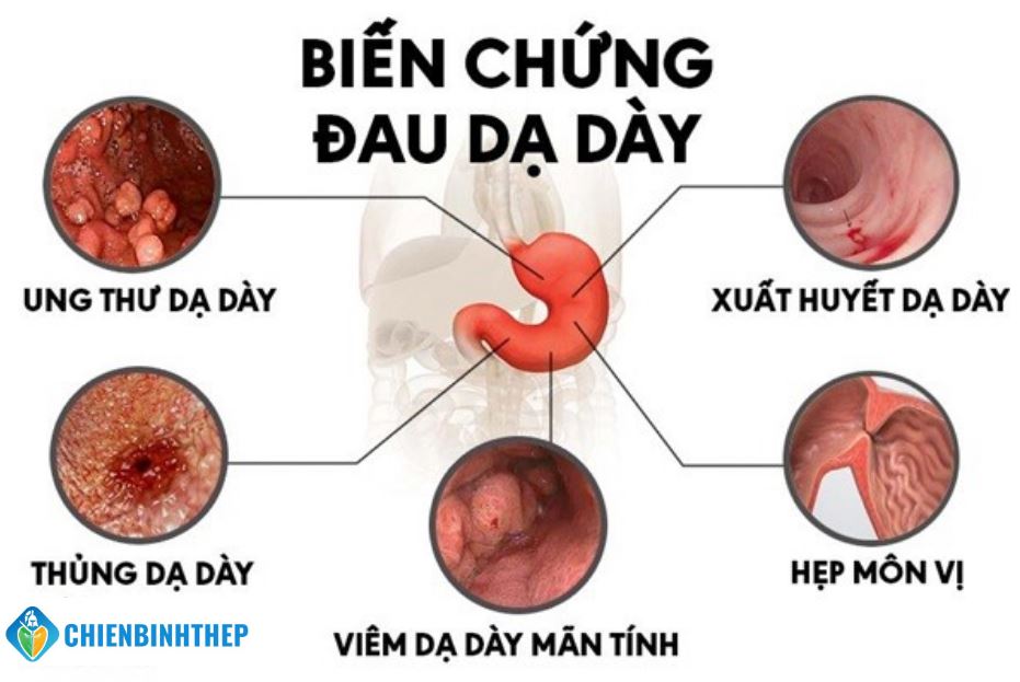 Biến chứng đau dạ dày