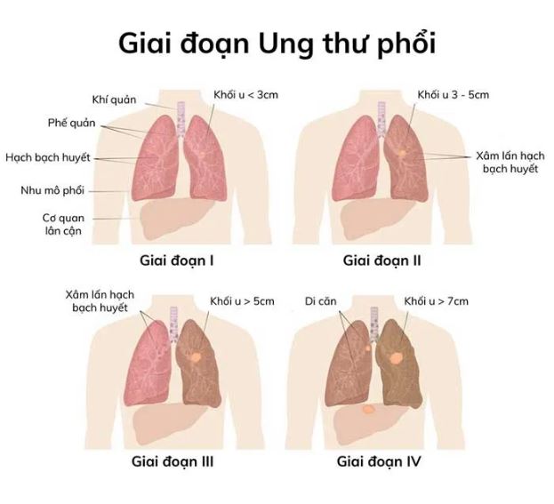 Các giai đoạn ung thư phổi