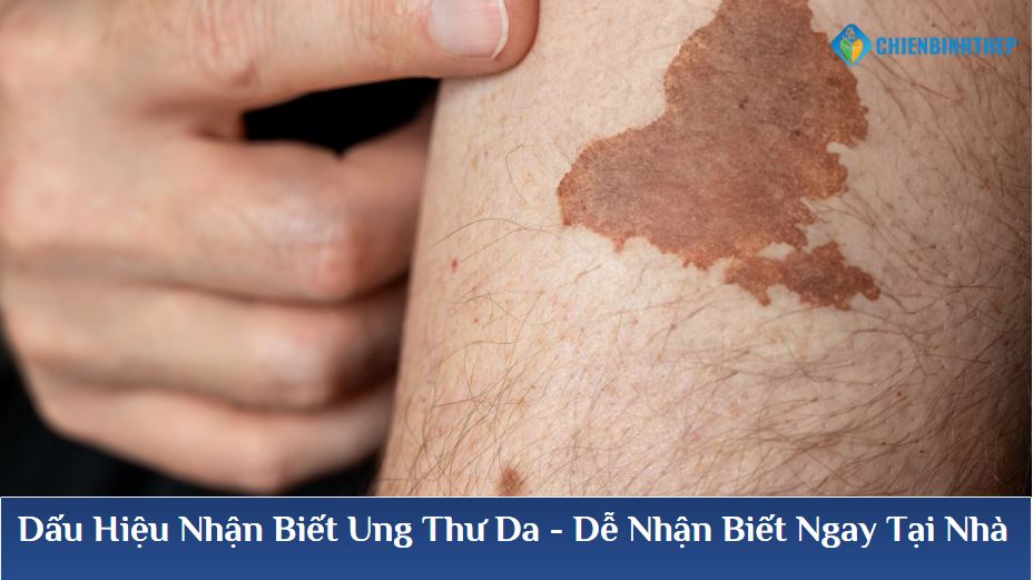 Ung thư da dễ nhận biết ngay tại nhà