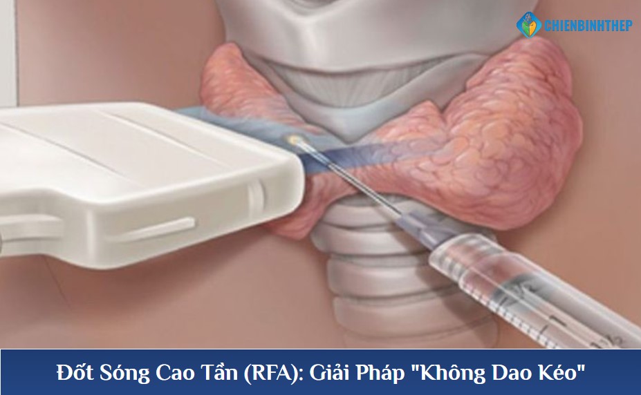 Đốt sóng cao tần RFA