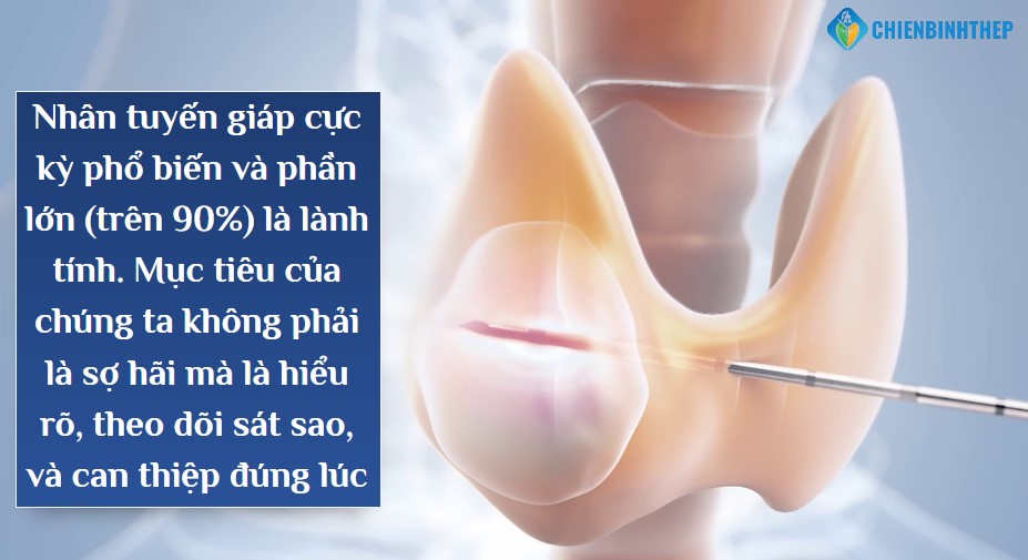 Nhân tuyến giáp trên 90% là lành tính