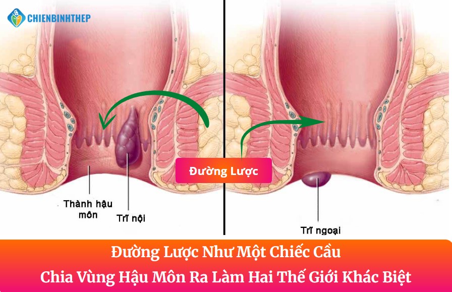 Phân biệt trĩ nội và trĩ ngoại