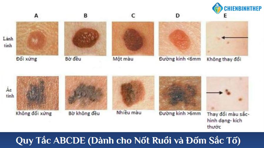 Quy tắc ABCDE dành cho nốt ruồi và đốm sắc tố