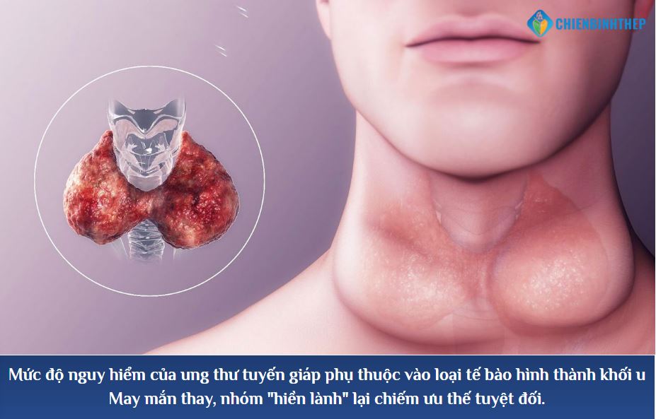 Mức độ nguy hiểm của ung thư tuyến giáp phụ thuộc vào loại tế bào hình thành khối u