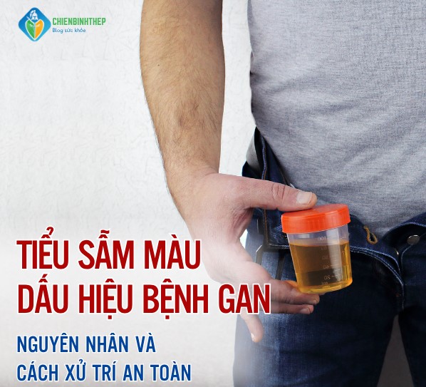 Nước Tiểu Sẫm Màu Dấu Hiệu Bệnh Gan