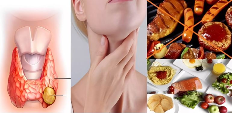 U tuyến giáp nên ăn gì
