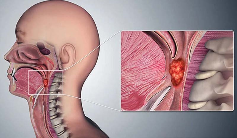 Ung thư vòm họng khó nuốt