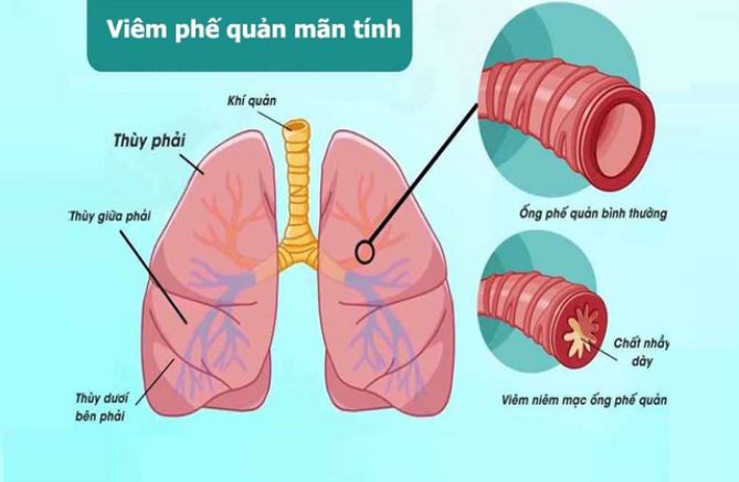 Triệu chứng viêm phế quản mạn tính
