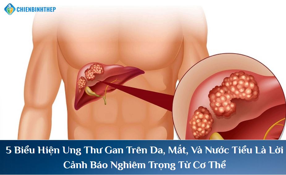5 biểu hiện ung thư gan
