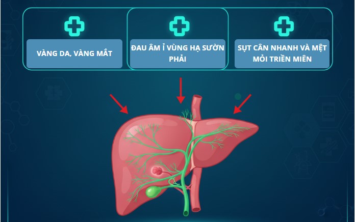 Ung Thư Đường Mật (ICC): 3 Dấu Hiệu Sớm