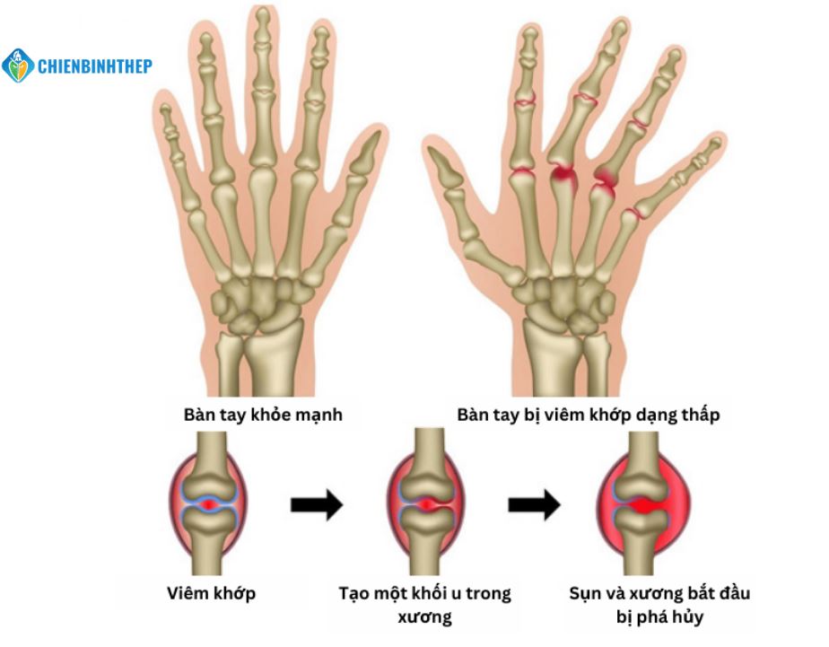 Bàn tay bị viêm khớp dạng thấp