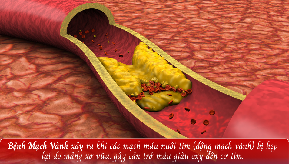 Bệnh Mạch Vành (Bệnh tim thiếu máu cục bộ)
