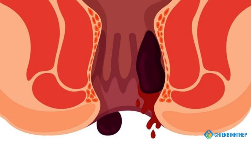 Bệnh trĩ chảy máu nguyên nhân do đâu
