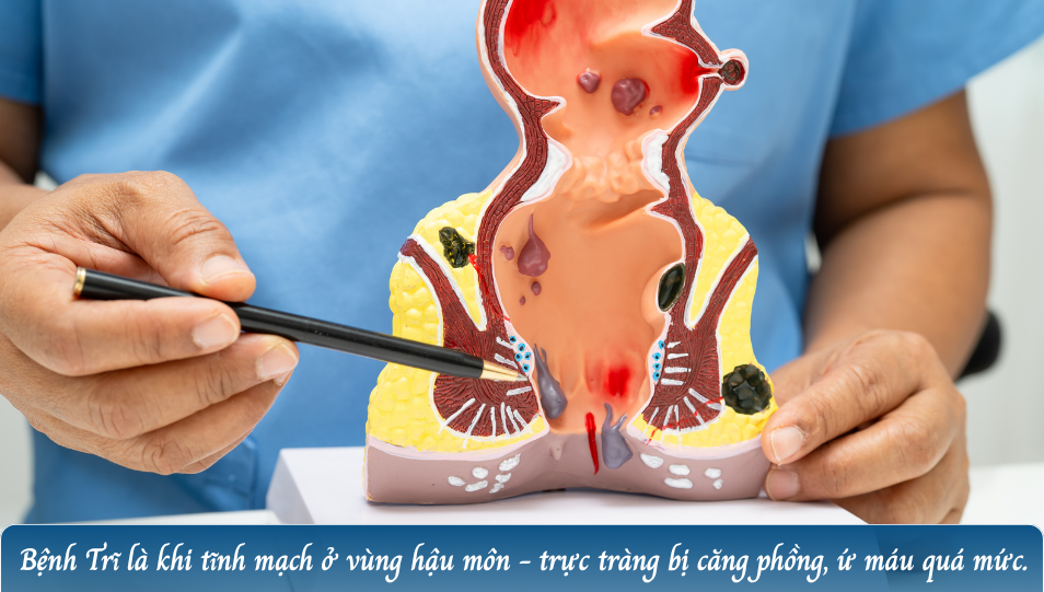 Bệnh trĩ hoàn toàn có thể được kiểm soát và điều trị triệt để!