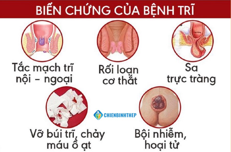 Biễn chứng bệnh trĩ