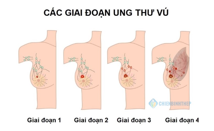 Các giai đoạn ung thư vú
