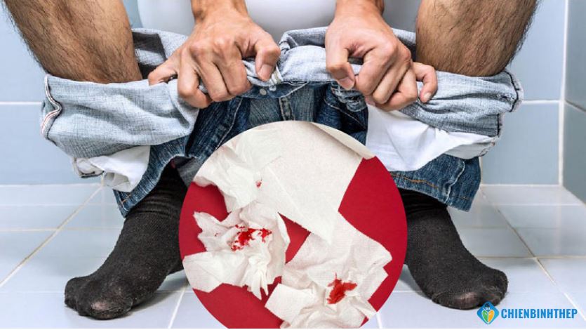 Cách cầm chảy máu do trĩ