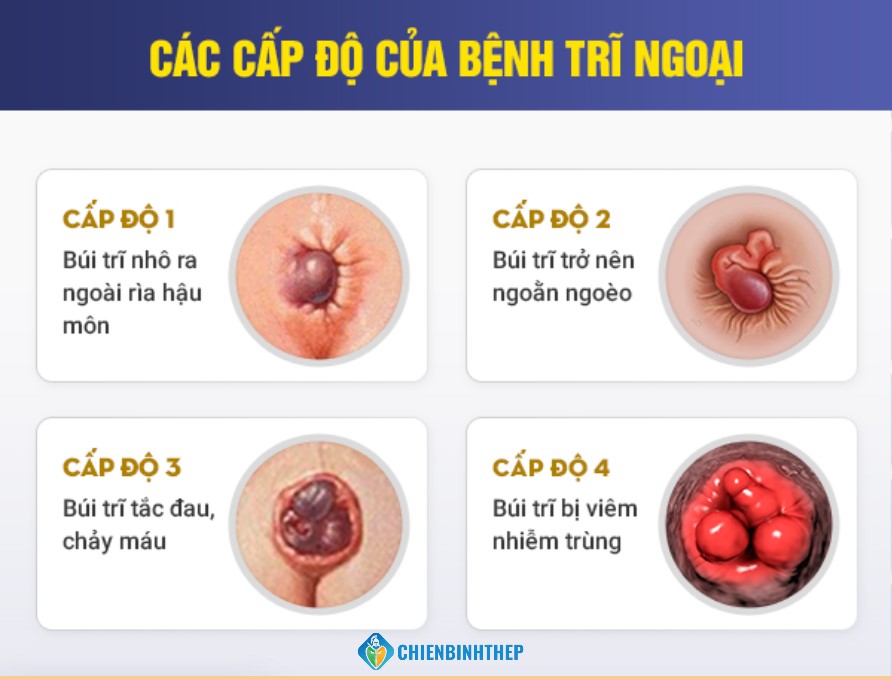 Các cấp độ của bệnh trĩ