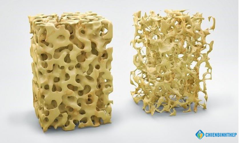 Dấu hiệu của loãng xương