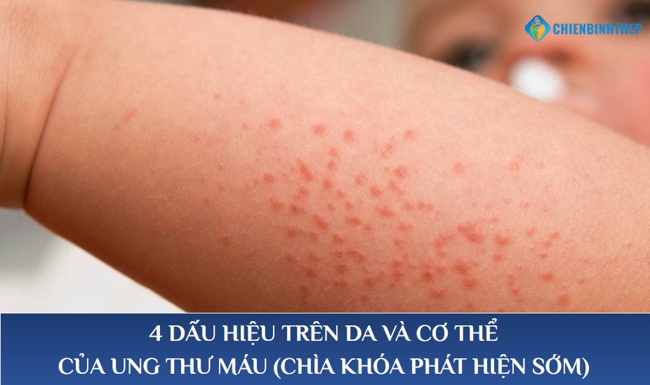 Dấu hiệu ung thư máu ở trẻ em