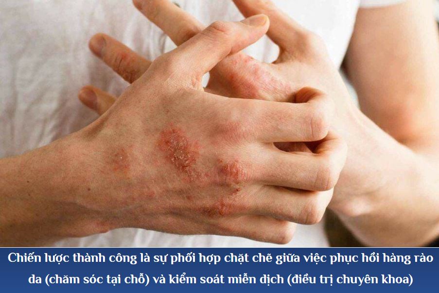 Diều trị đa tầng cho viêm da cơ địa