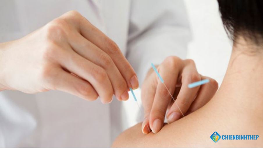 Điều trị đau vai gáy