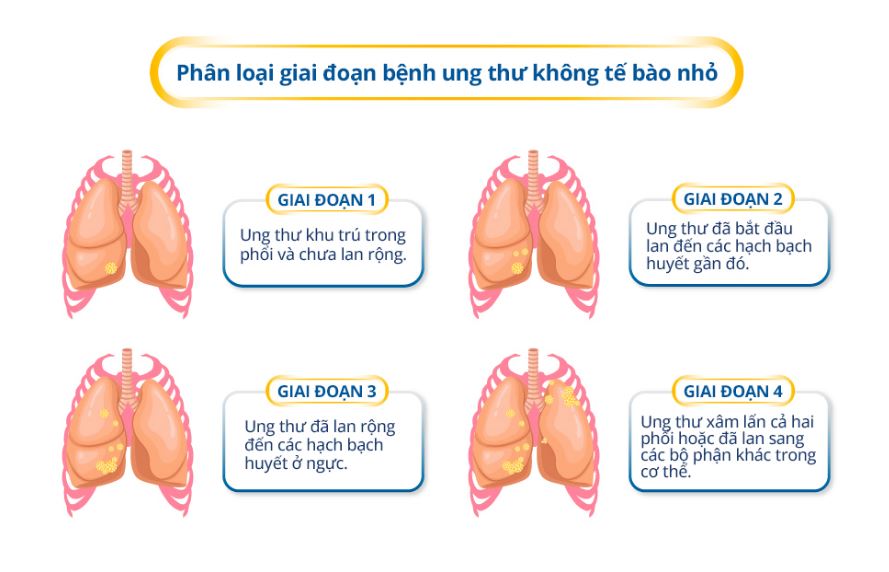 Các giai đoạn ung thư phổi