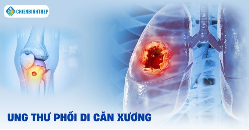 Giảm đau ung thư phổi di căn xương