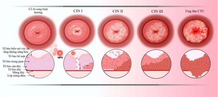 HPV gây ung thư cổ tử cung