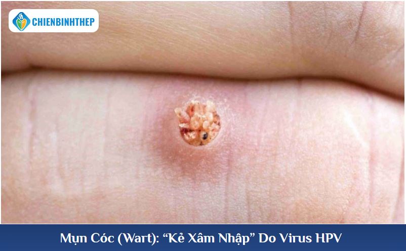 Mụn cóc do virus HPV