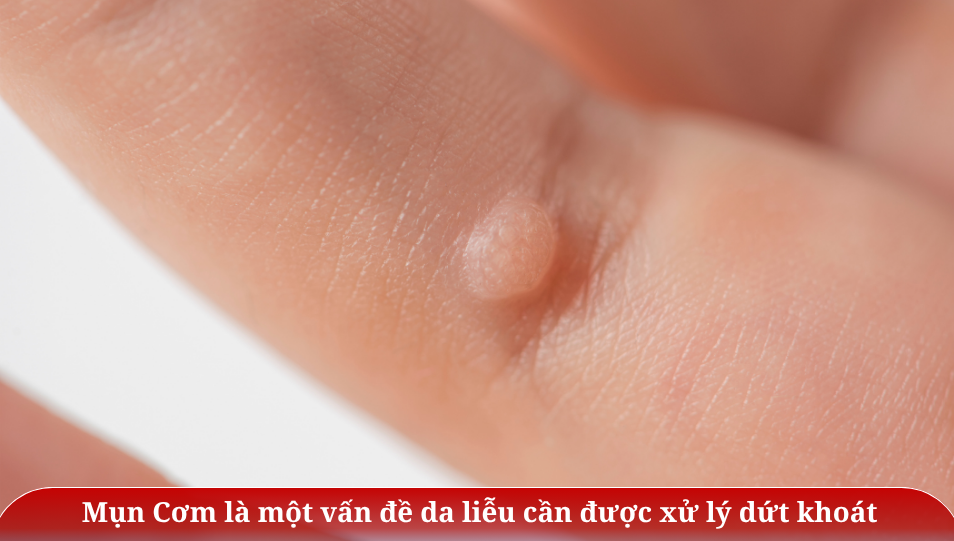 Mụn cơm là vấn dễ da liễu cần xử lý dứt khoát