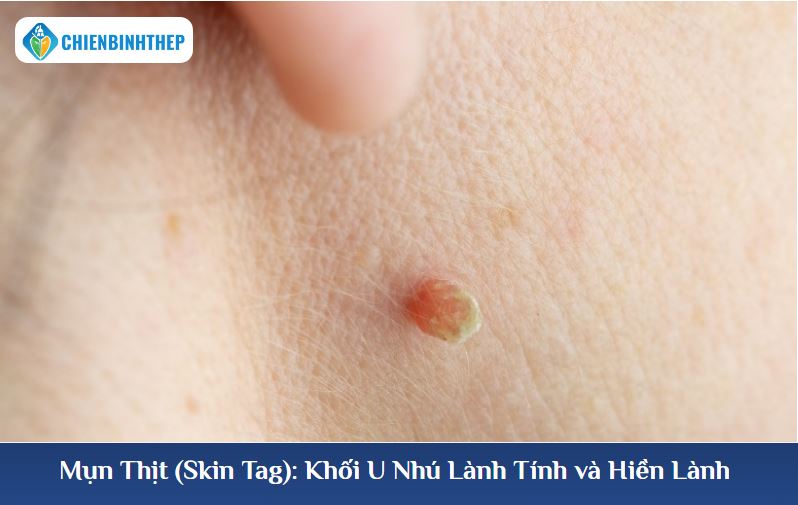 Mụn thịt là khối u lành tính