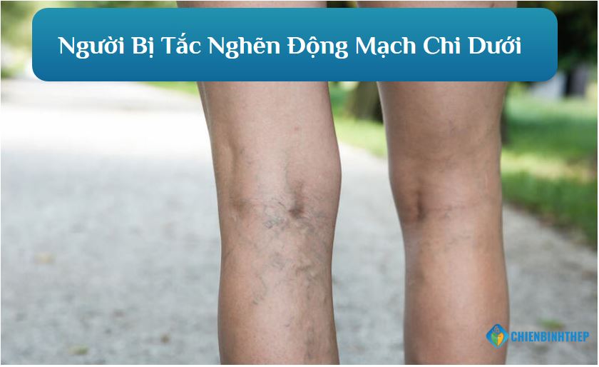 Người suy giãn tĩnh mạch không nên ngâm chân nước nóng