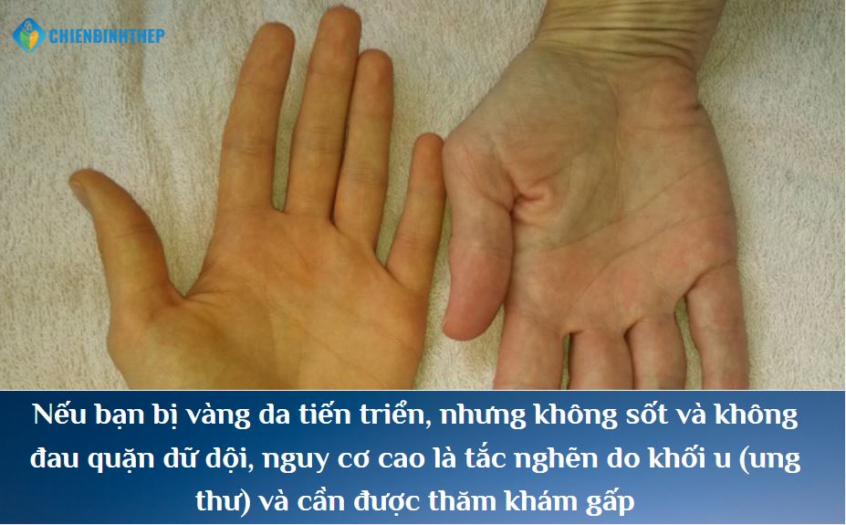 Phân Biệt Tắc Mật: Ung Thư Hay Sỏi Mật?