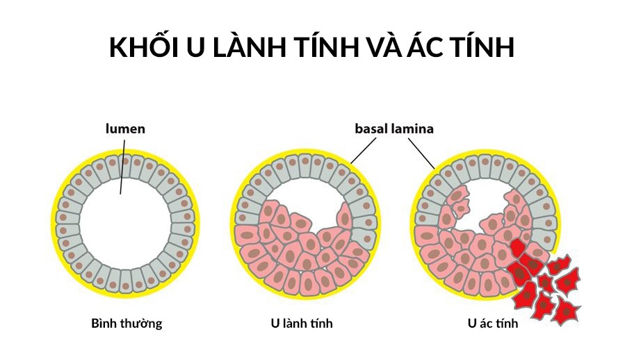phân biệt u gan lành tính và ác tính