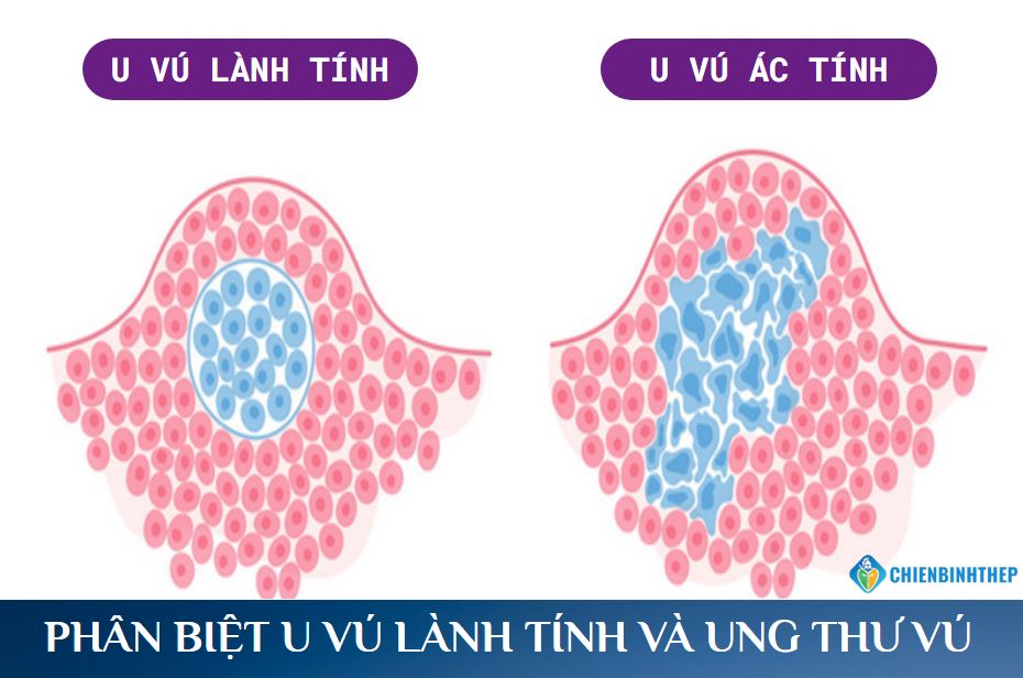 Phân biệt u vú lành tính và ung thư vú