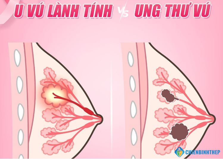 Phân biệt u vú lành tính với ung thư vú