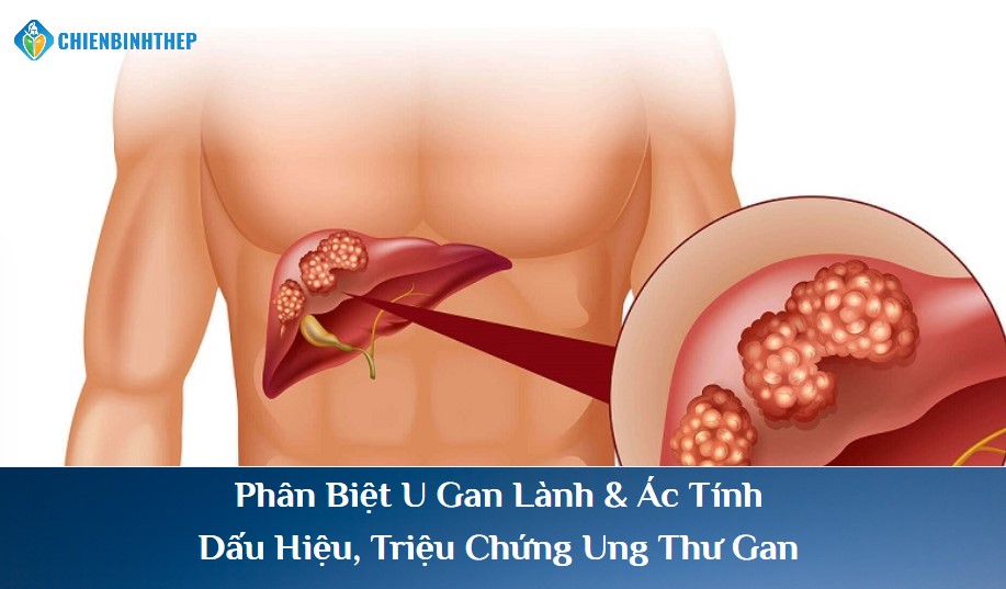 DẤU HIỆU PHÂN BIỆT U GAN LÀNH TÍNH VÀ UNG THƯ GAN (U ÁC TÍNH)