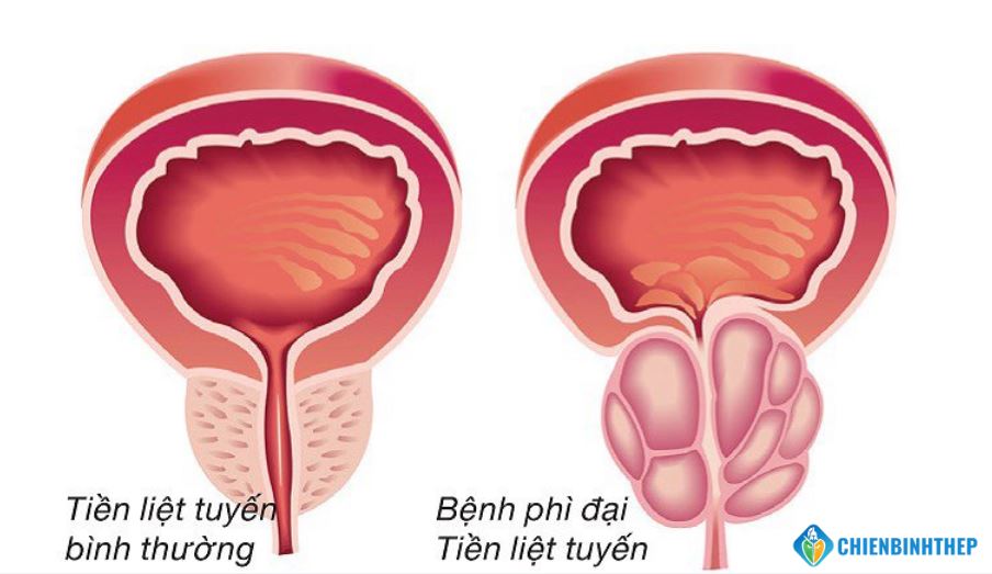 Phì đại tuyến tiền liệt