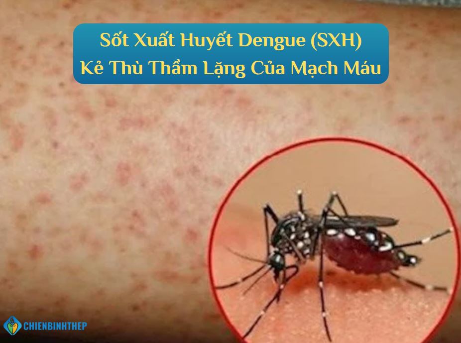 Sốt Xuất Huyết Dengue (SXH) – Kẻ Thù Thầm Lặng Của Mạch Máu